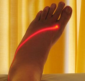 laser treatment of varicose veins in legs