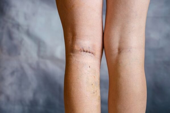 leg stitching after varicose vein surgery