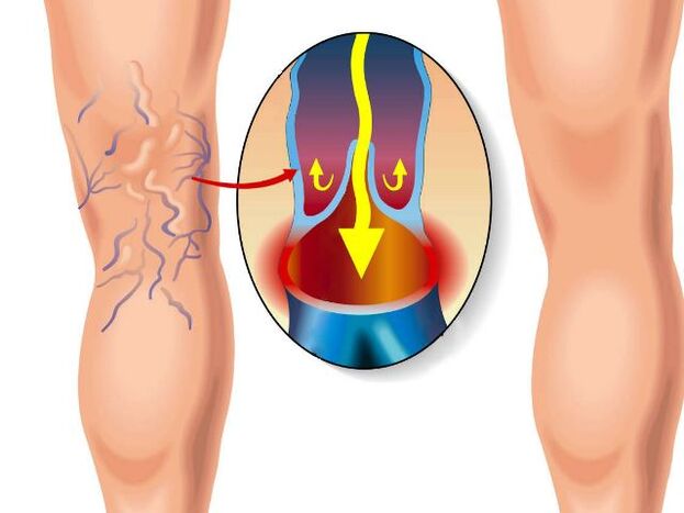 healthy leg and varicose veins in leg