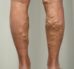leg nodules with varicose veins