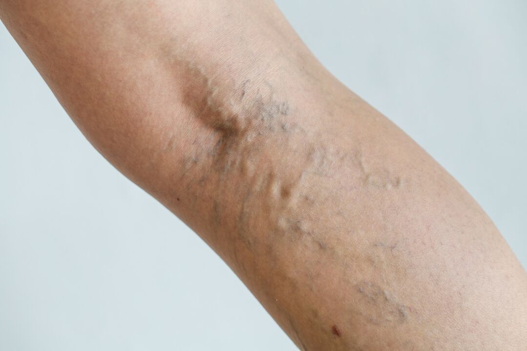 varicose veins in the leg photo 1