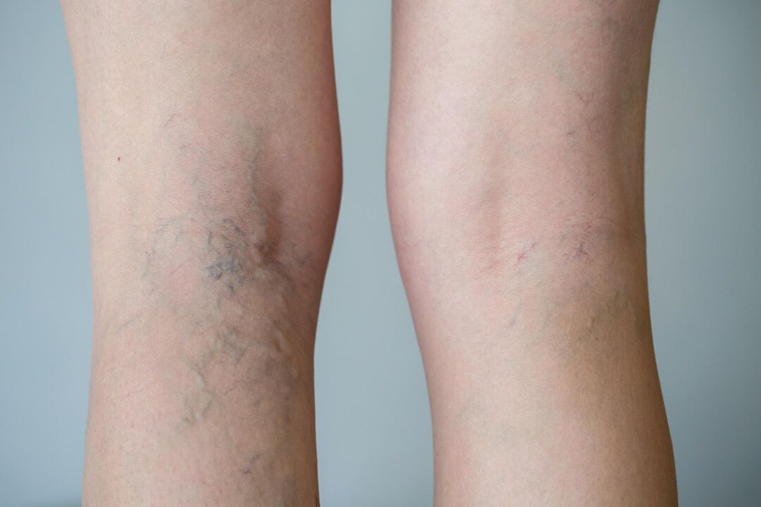 varicose veins in the leg photo 2