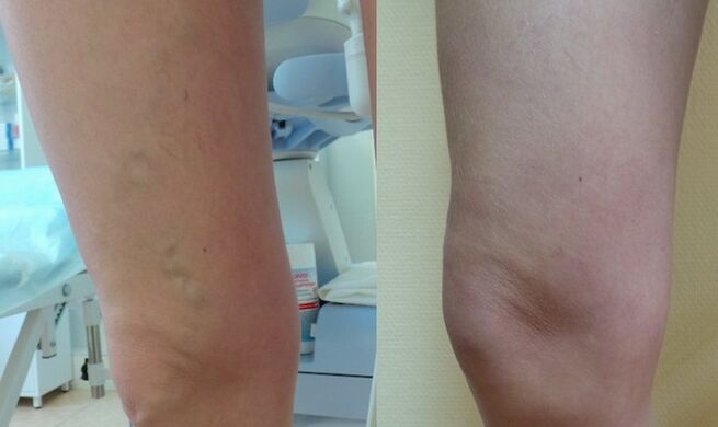 leg before and after treatment for reticular varices