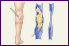Sclerotherapy is a popular method to get rid of varicose veins in the legs. 