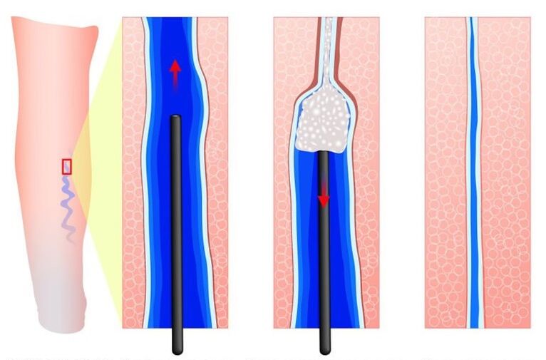 sclerotherapy for lip varices