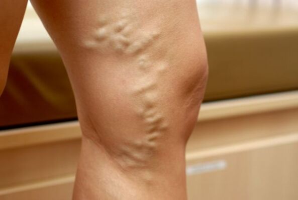 varicose veins in the leg with varicose veins in the small pelvis