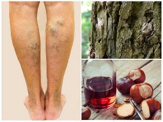the vein treatment on legs folk remedies