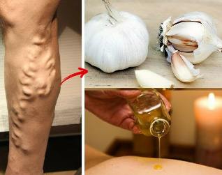 remedies for varicose veins