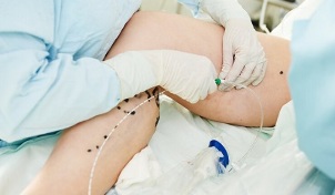 methods of treating varicose veins in the legs in women