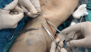 how phlebetomy is performed to remove varicose veins