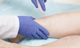 treatment of varicose veins